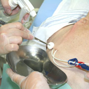 infection_catetale